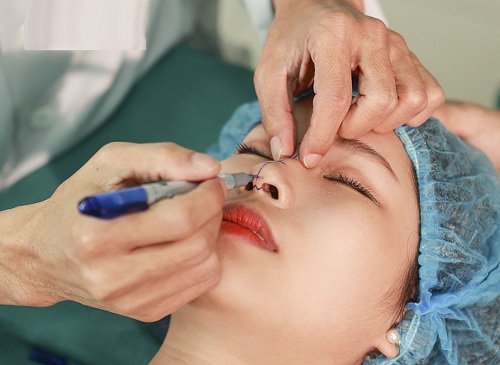 Quy trình nâng mũi phải đảm bảo đáp ứng yêu cầu khắt khe của Bộ Y tế.